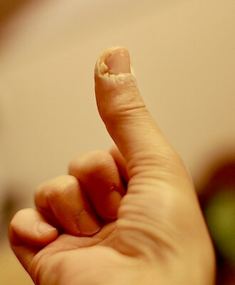親指の肉芽腫